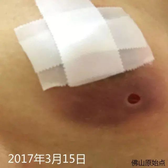 原始点调理乳房溃烂:一位德国媳妇飞越半球的原始点求医经历 原始点调理乳房溃烂:一位德国媳妇飞越半球的原始点求医经历