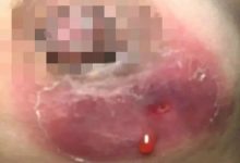 原始点调理乳房溃烂:一位德国媳妇Wendy飞越半球的原始点求医经历2017年3月-原始点全球同学网