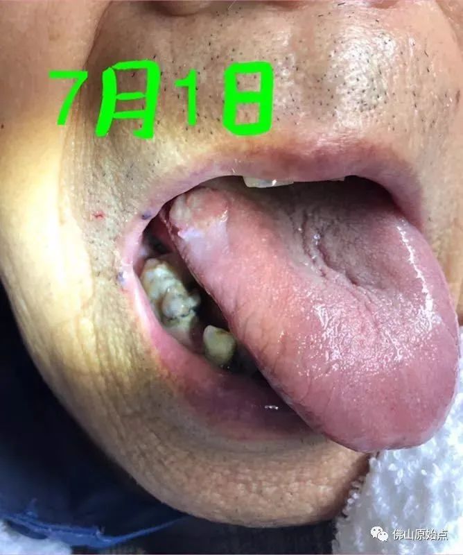 原始点调理疑似舌癌:简单相信实干收获快 原始点调理疑似舌癌:简单相信实干收获快