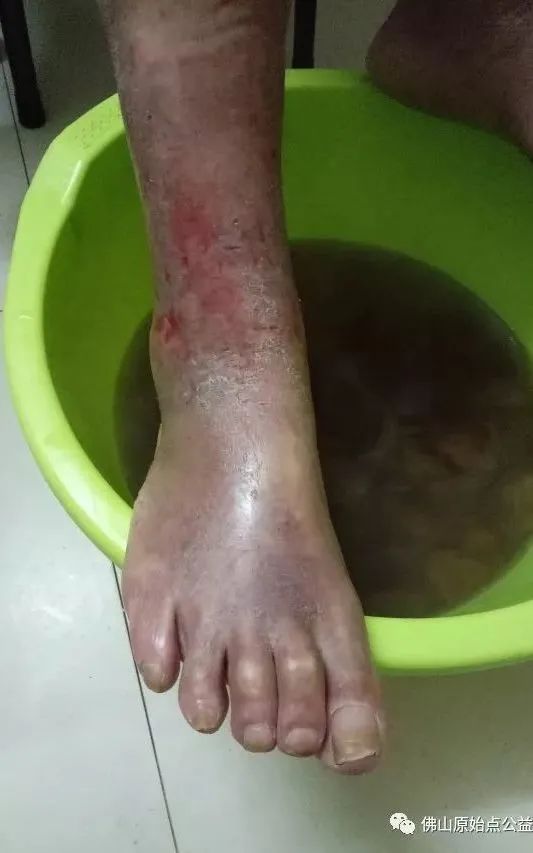 原始点调理全身肿胀溃烂:九个月,雨过天睛 原始点调理全身肿胀溃烂:九个月,雨过天睛