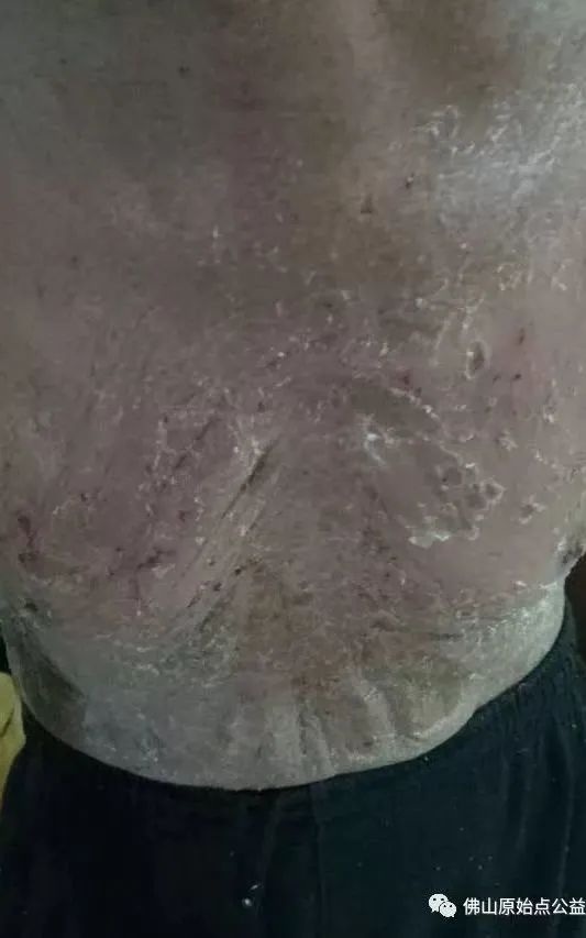 原始点调理全身肿胀溃烂:九个月,雨过天睛 原始点调理全身肿胀溃烂:九个月,雨过天睛