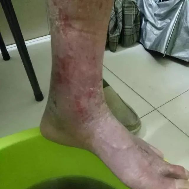 原始点调理全身肿胀溃烂:九个月,雨过天睛 原始点调理全身肿胀溃烂:九个月,雨过天睛