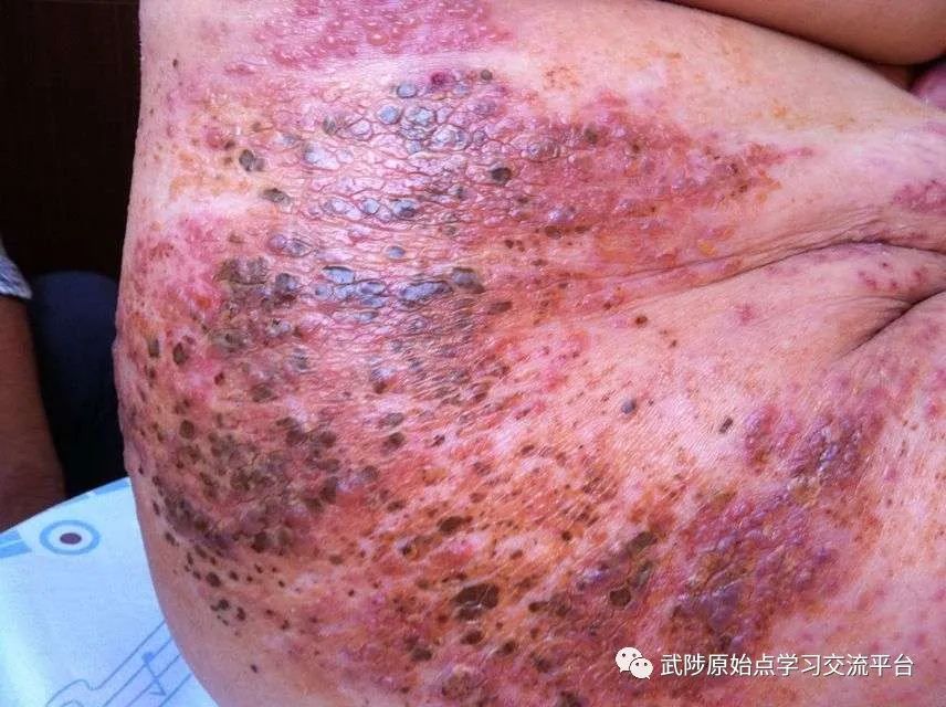 带状疱疹案例 带状疱疹案例