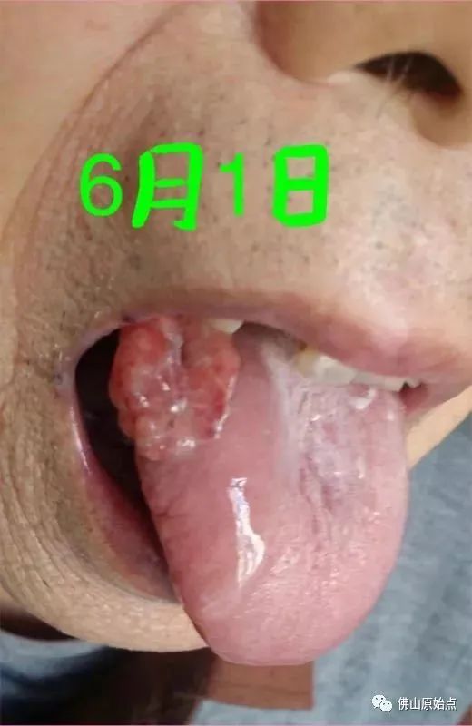 原始点调理疑似舌癌:简单相信实干收获快 原始点调理疑似舌癌:简单相信实干收获快