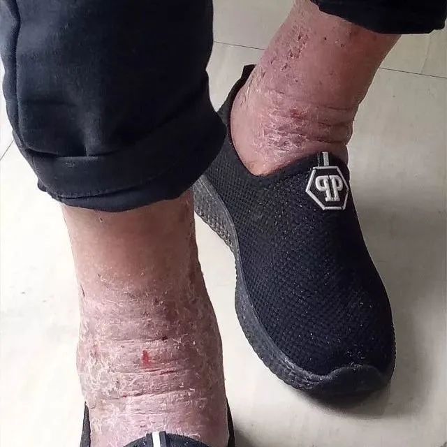 原始点调理全身肿胀溃烂:九个月,雨过天睛 原始点调理全身肿胀溃烂:九个月,雨过天睛