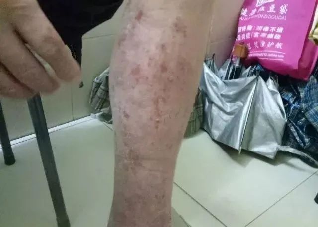 原始点调理全身肿胀溃烂:九个月,雨过天睛 原始点调理全身肿胀溃烂:九个月,雨过天睛