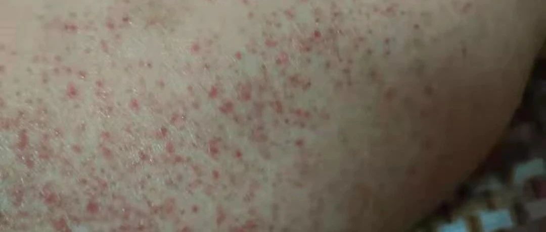 术后药物引起皮肤过敏案例-原始点全球同学网