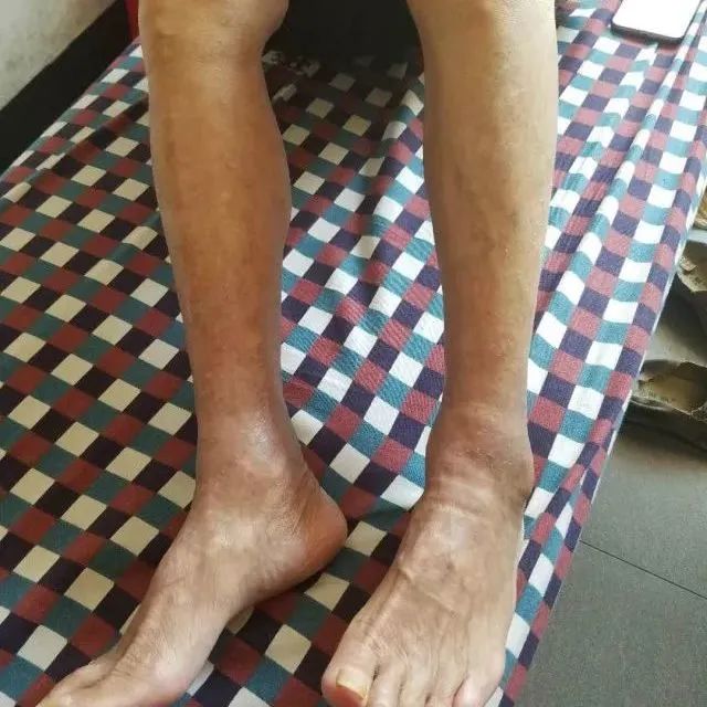 原始点调理全身肿胀溃烂:九个月,雨过天睛 原始点调理全身肿胀溃烂:九个月,雨过天睛