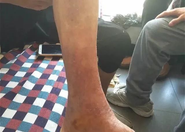 原始点调理全身肿胀溃烂:九个月,雨过天睛 原始点调理全身肿胀溃烂:九个月,雨过天睛