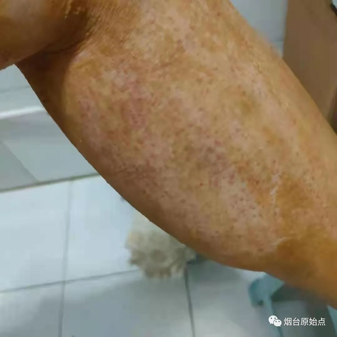 术后药物引起皮肤过敏案例