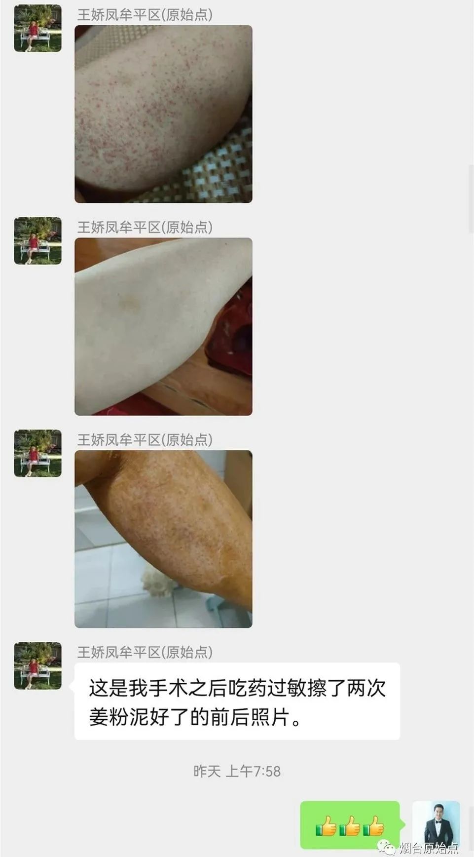 术后药物引起皮肤过敏案例