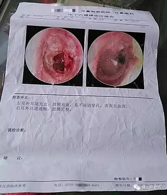 原始点康复耳膜穿孔与失聪 原始点康复耳膜穿孔与失聪