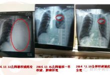 38岁山东淄博邢家祥 五个月一个晚期癌症患者的奇迹康复之路①-原始点全球同学网