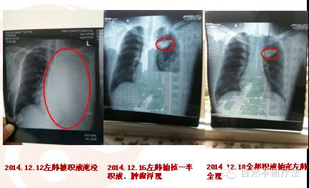 38岁山东淄博邢家祥 五个月一个晚期癌症患者的奇迹康复之路①-原始点全球同学网