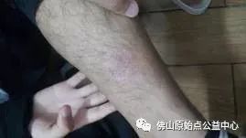 原始点调理九年史牛皮癣:二十天大变化 原始点调理九年史牛皮癣:二十天大变化