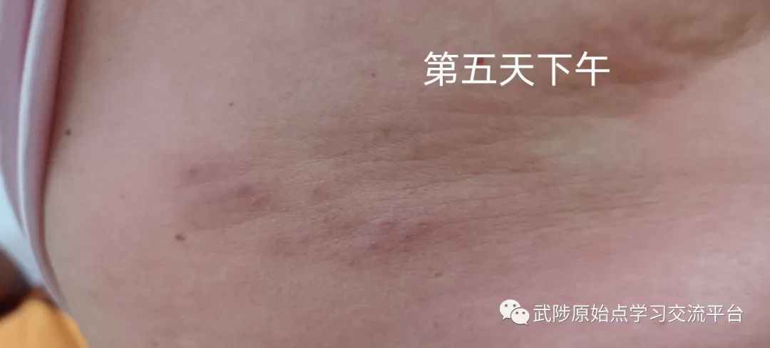 带状疱疹案例 带状疱疹案例