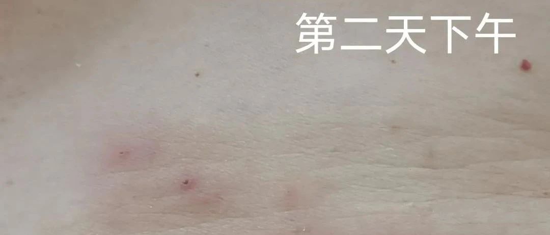 厦门周女士分享婆婆带状疱疹案例-原始点全球同学网