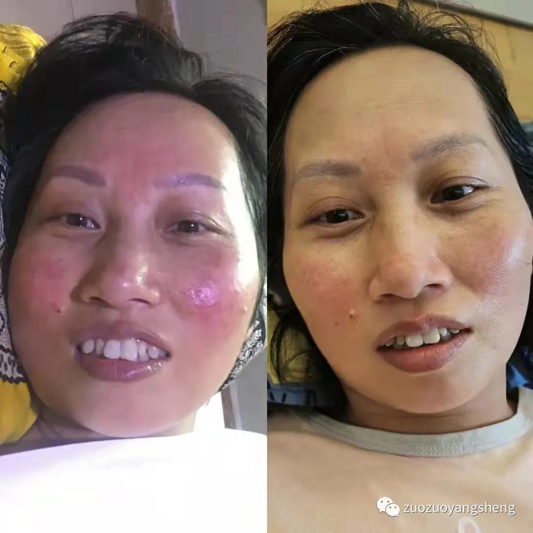 案例分享:原始点调理脸上严重玫瑰痤疮的案例 案例分享:原始点调理脸上严重玫瑰痤疮的案例