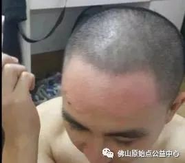 原始点调理九年史牛皮癣:二十天大变化 原始点调理九年史牛皮癣:二十天大变化