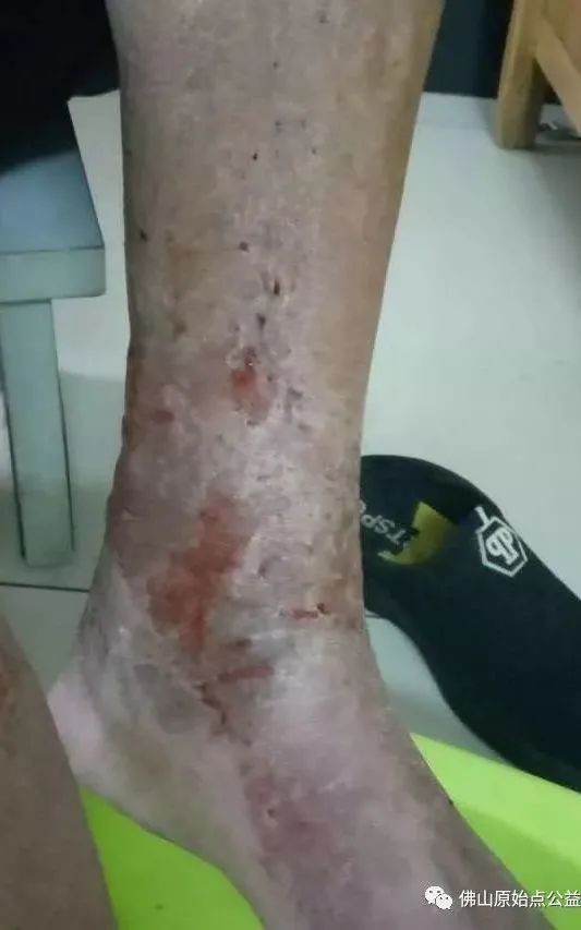 原始点调理全身肿胀溃烂:九个月,雨过天睛 原始点调理全身肿胀溃烂:九个月,雨过天睛