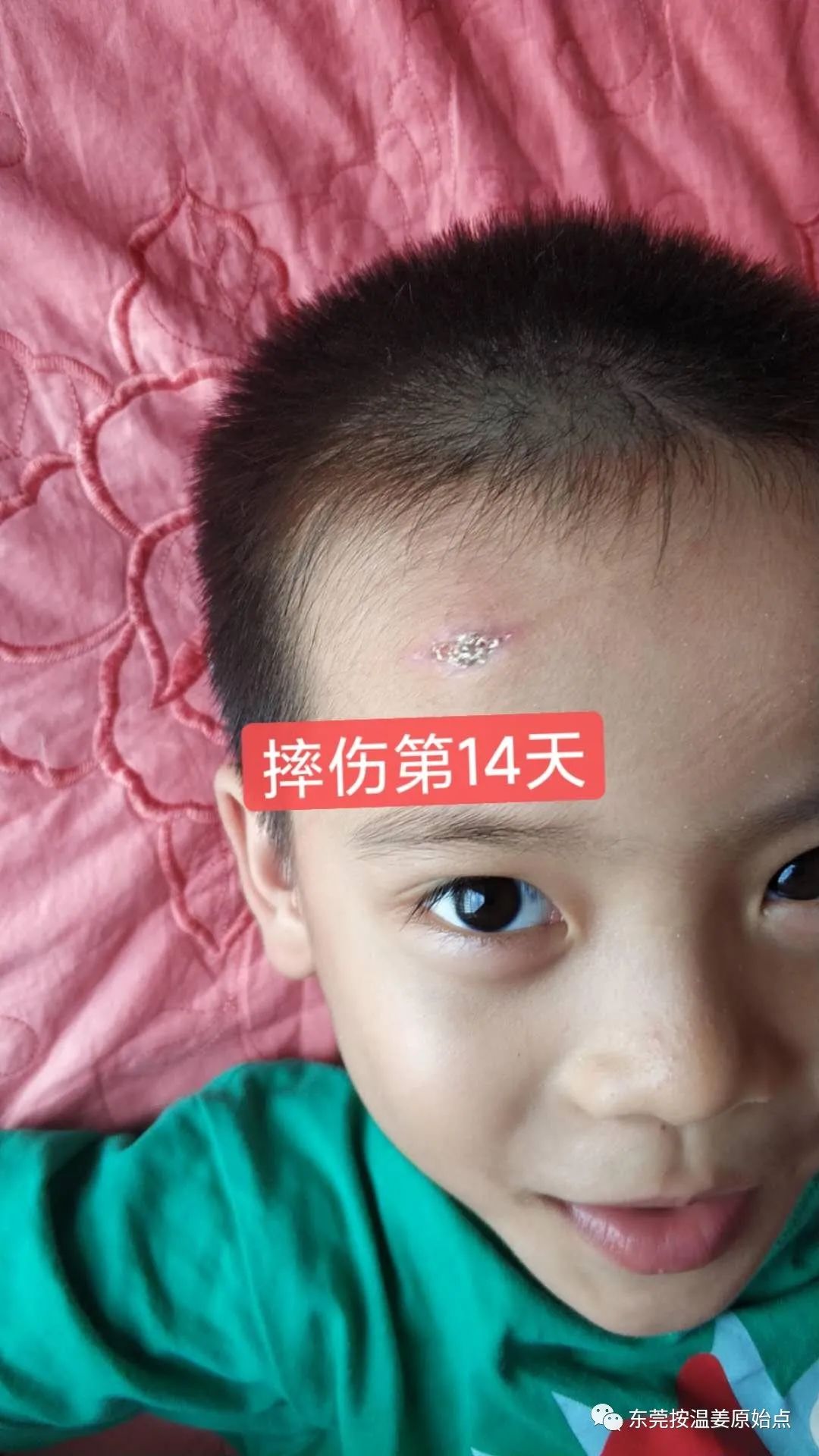 摔伤伤口大约长2CM深0.5CM,未缝针 摔伤伤口大约长2CM深0.5CM,未缝针