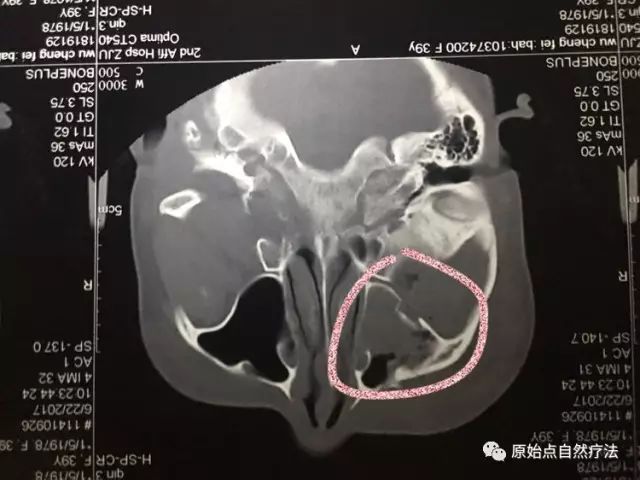 调理车祸案例 调理车祸案例