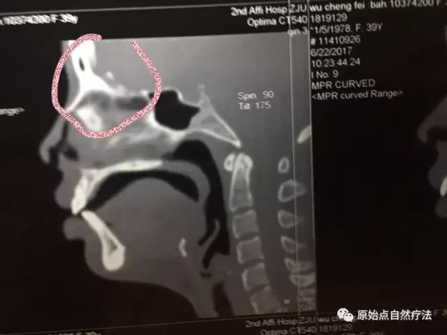 调理车祸案例 调理车祸案例