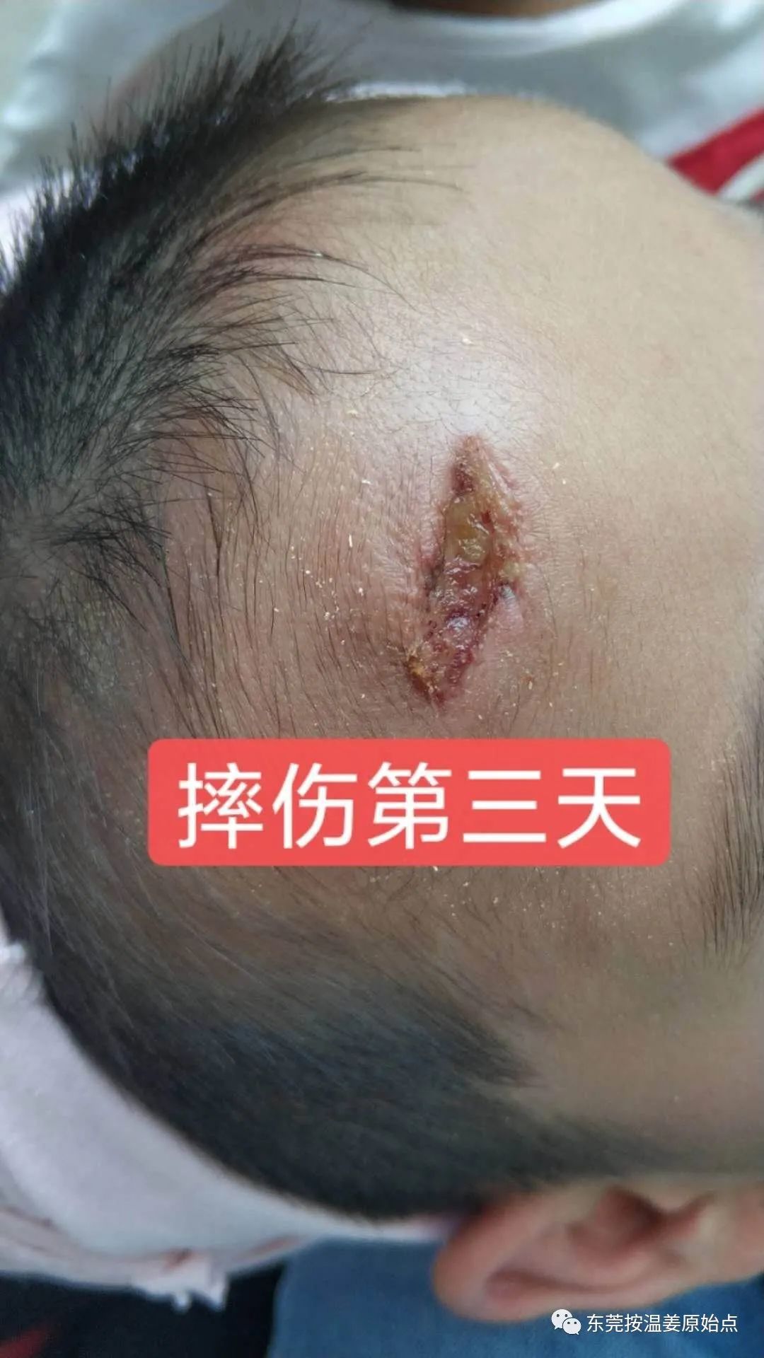 摔伤伤口大约长2CM深0.5CM,未缝针 摔伤伤口大约长2CM深0.5CM,未缝针