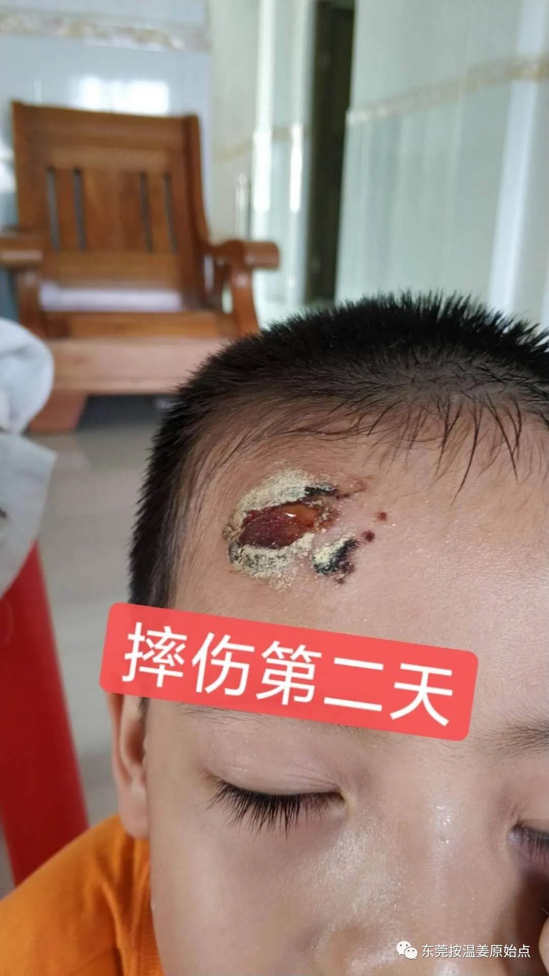 摔伤伤口大约长2CM深0.5CM,未缝针 摔伤伤口大约长2CM深0.5CM,未缝针
