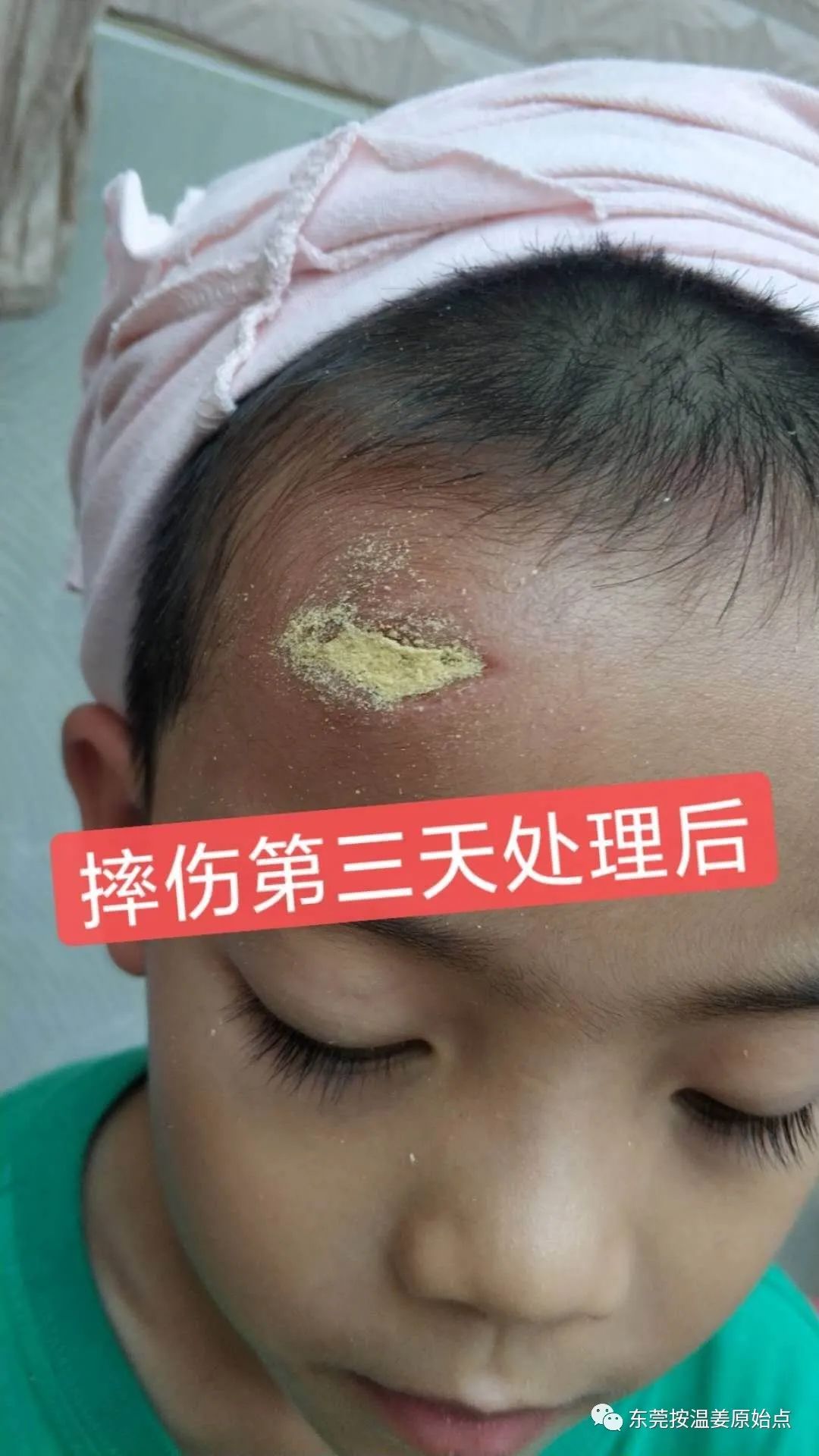 摔伤伤口大约长2CM深0.5CM,未缝针 摔伤伤口大约长2CM深0.5CM,未缝针