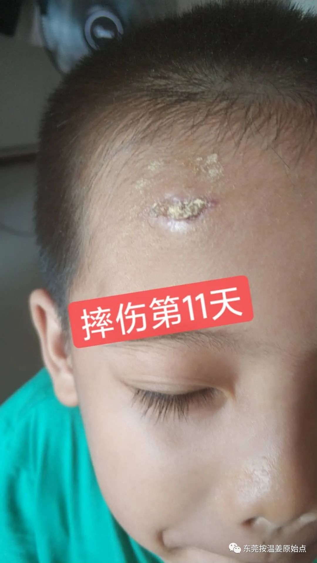 摔伤伤口大约长2CM深0.5CM,未缝针 摔伤伤口大约长2CM深0.5CM,未缝针