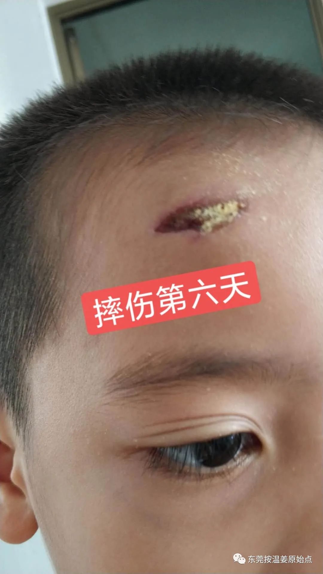 摔伤伤口大约长2CM深0.5CM,未缝针 摔伤伤口大约长2CM深0.5CM,未缝针