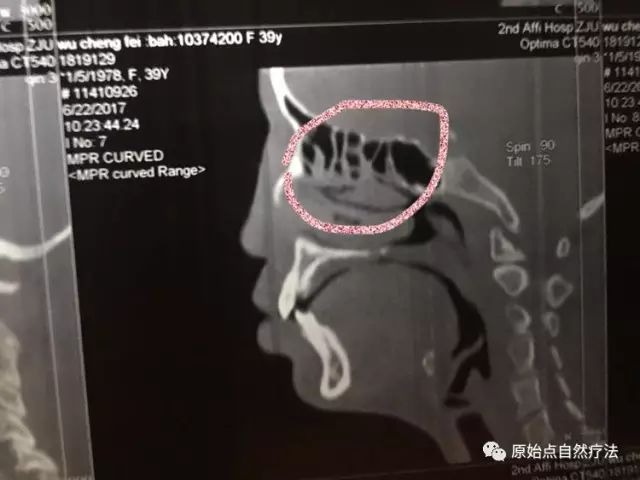 调理车祸案例 调理车祸案例