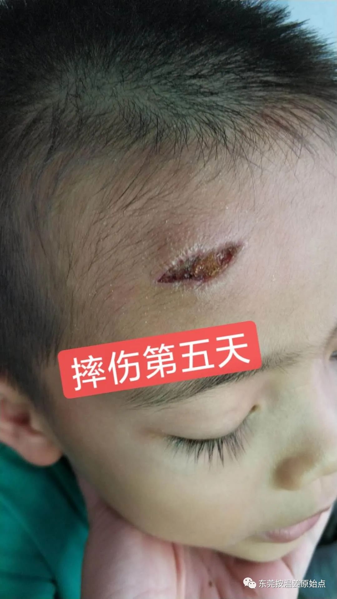 摔伤伤口大约长2CM深0.5CM,未缝针 摔伤伤口大约长2CM深0.5CM,未缝针