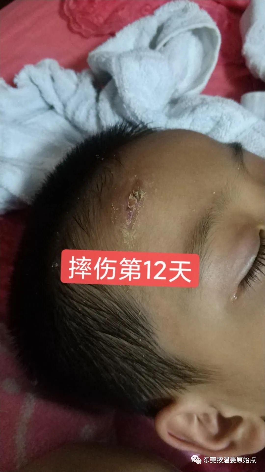 摔伤伤口大约长2CM深0.5CM,未缝针 摔伤伤口大约长2CM深0.5CM,未缝针