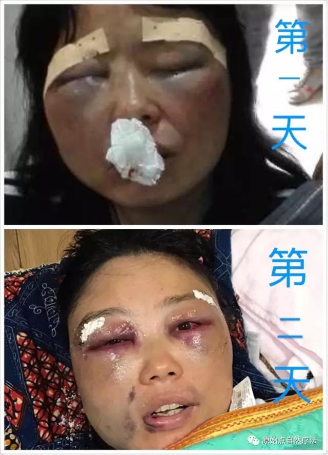 调理车祸案例 调理车祸案例