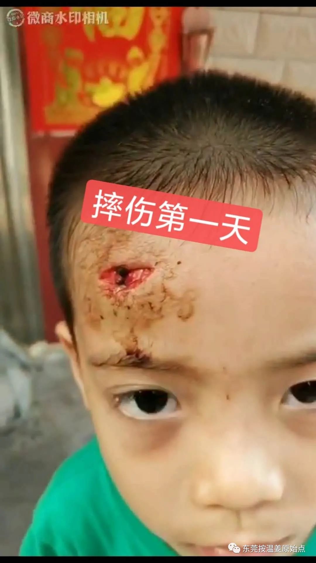 摔伤伤口大约长2CM深0.5CM,未缝针 摔伤伤口大约长2CM深0.5CM,未缝针