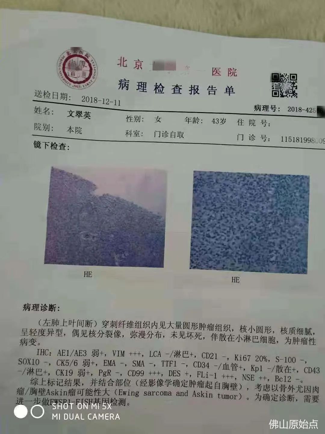 原始点调理锁骨瘤案例 原始点调理锁骨瘤案例