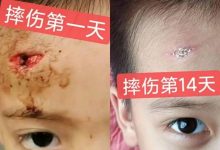摔伤伤口大约长2CM深0.5CM,未缝针-原始点全球同学网