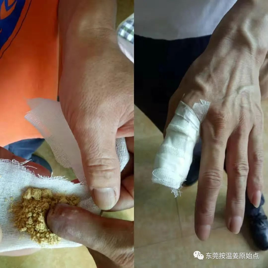 伤口不愈合，红肿不消