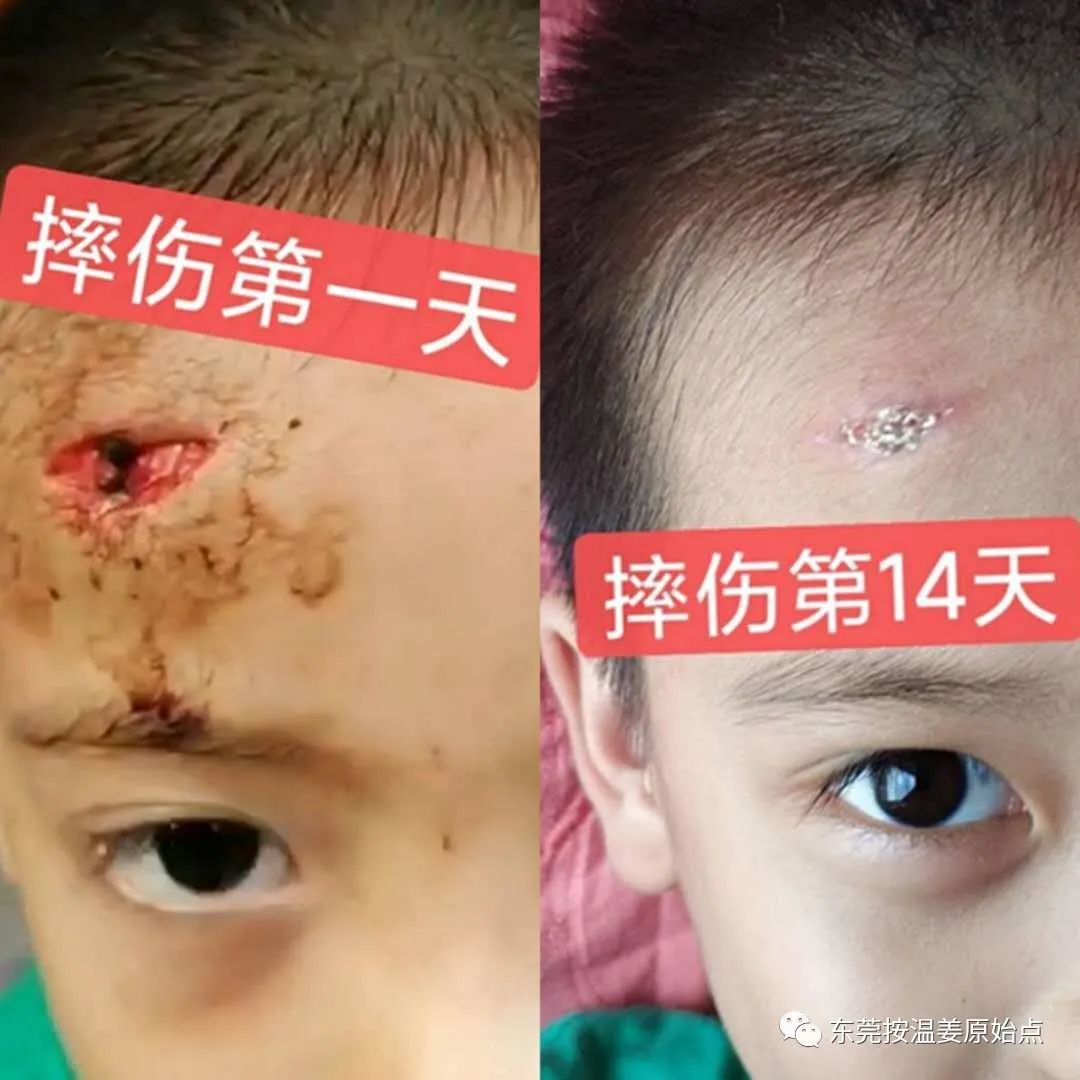 摔伤伤口大约长2CM深0.5CM,未缝针 摔伤伤口大约长2CM深0.5CM,未缝针