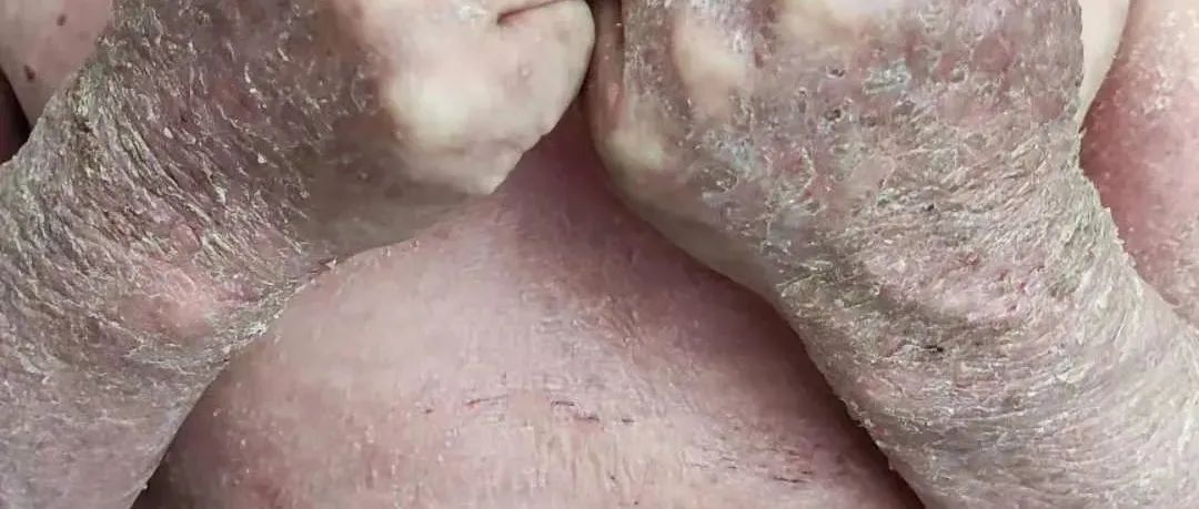 自行在家调理全身严重湿疹-原始点全球同学网