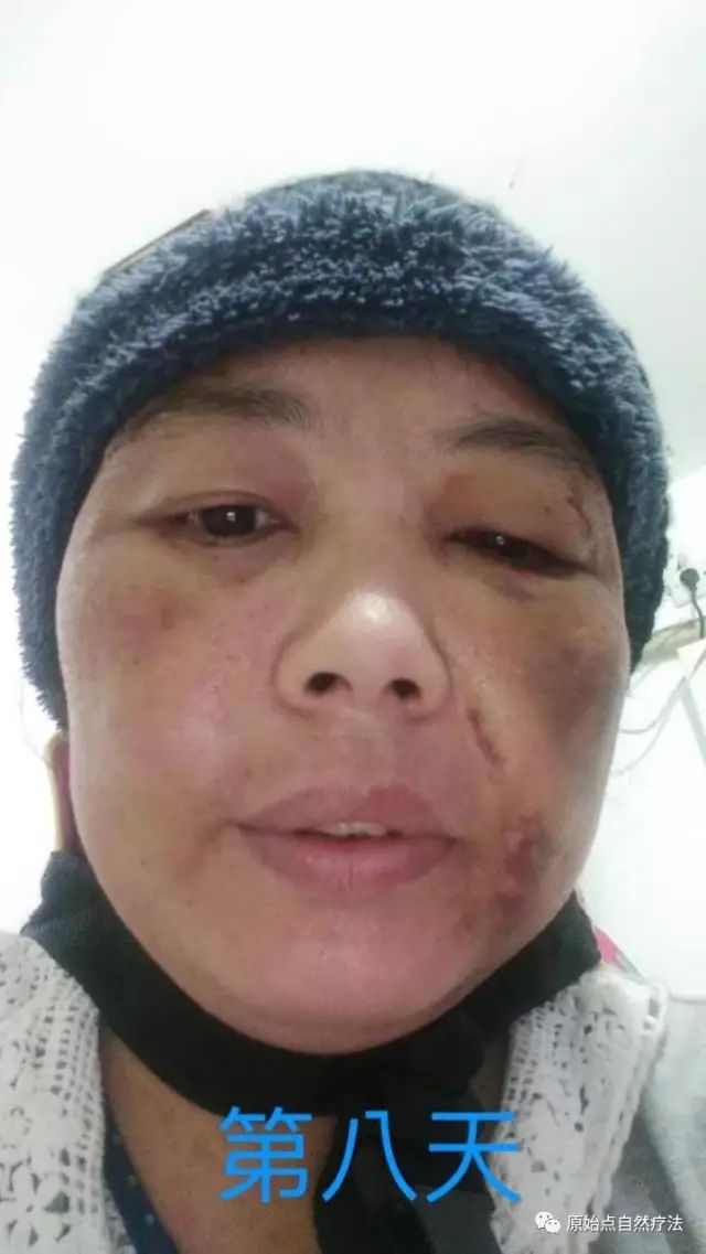 调理车祸案例 调理车祸案例