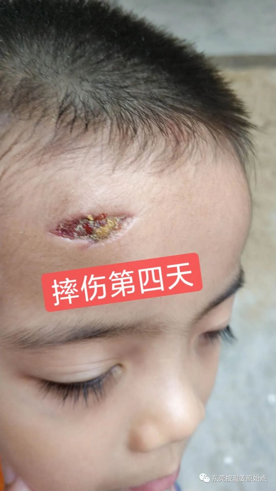 摔伤伤口大约长2CM深0.5CM,未缝针 摔伤伤口大约长2CM深0.5CM,未缝针