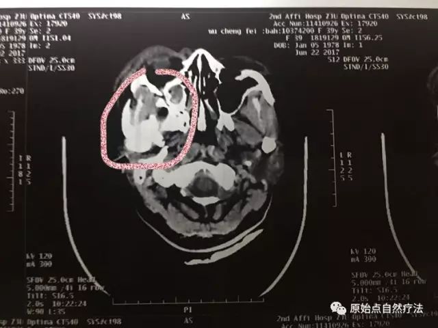 调理车祸案例 调理车祸案例