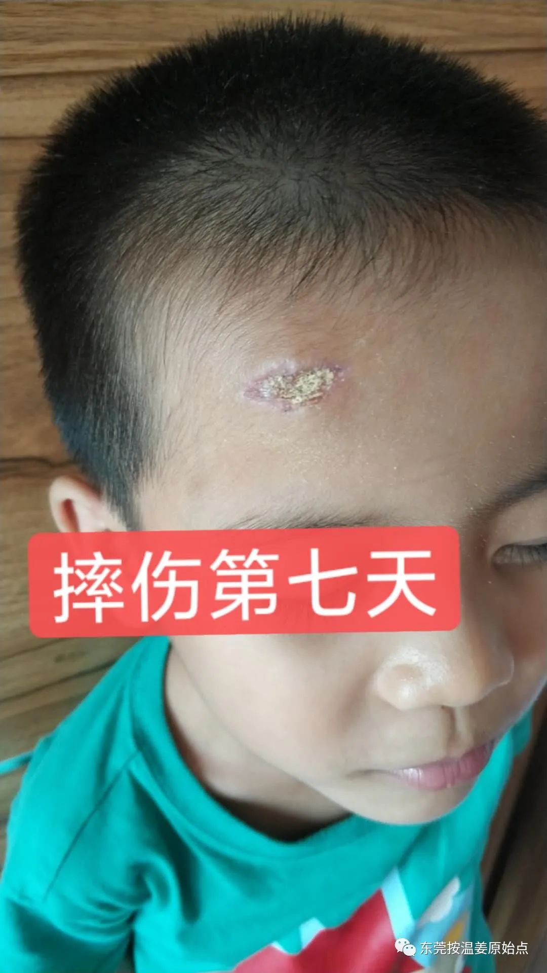 摔伤伤口大约长2CM深0.5CM,未缝针 摔伤伤口大约长2CM深0.5CM,未缝针
