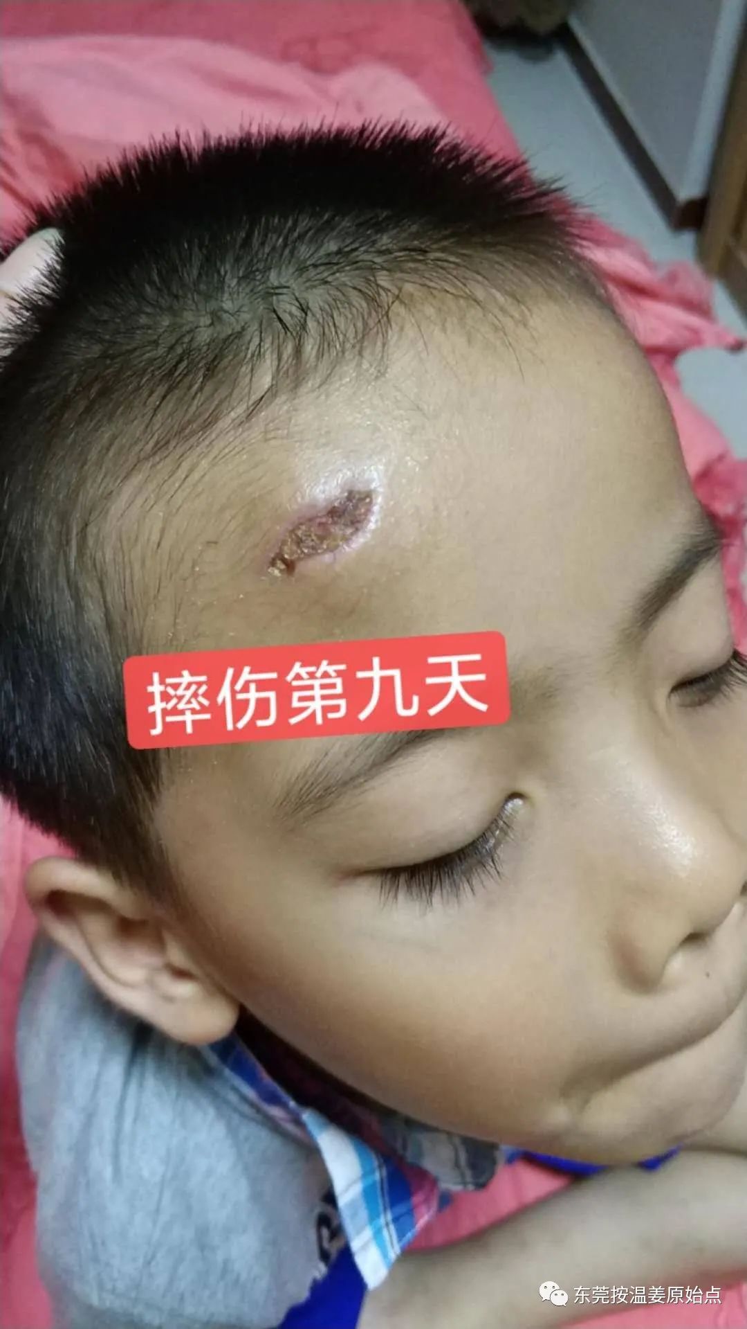 摔伤伤口大约长2CM深0.5CM,未缝针 摔伤伤口大约长2CM深0.5CM,未缝针