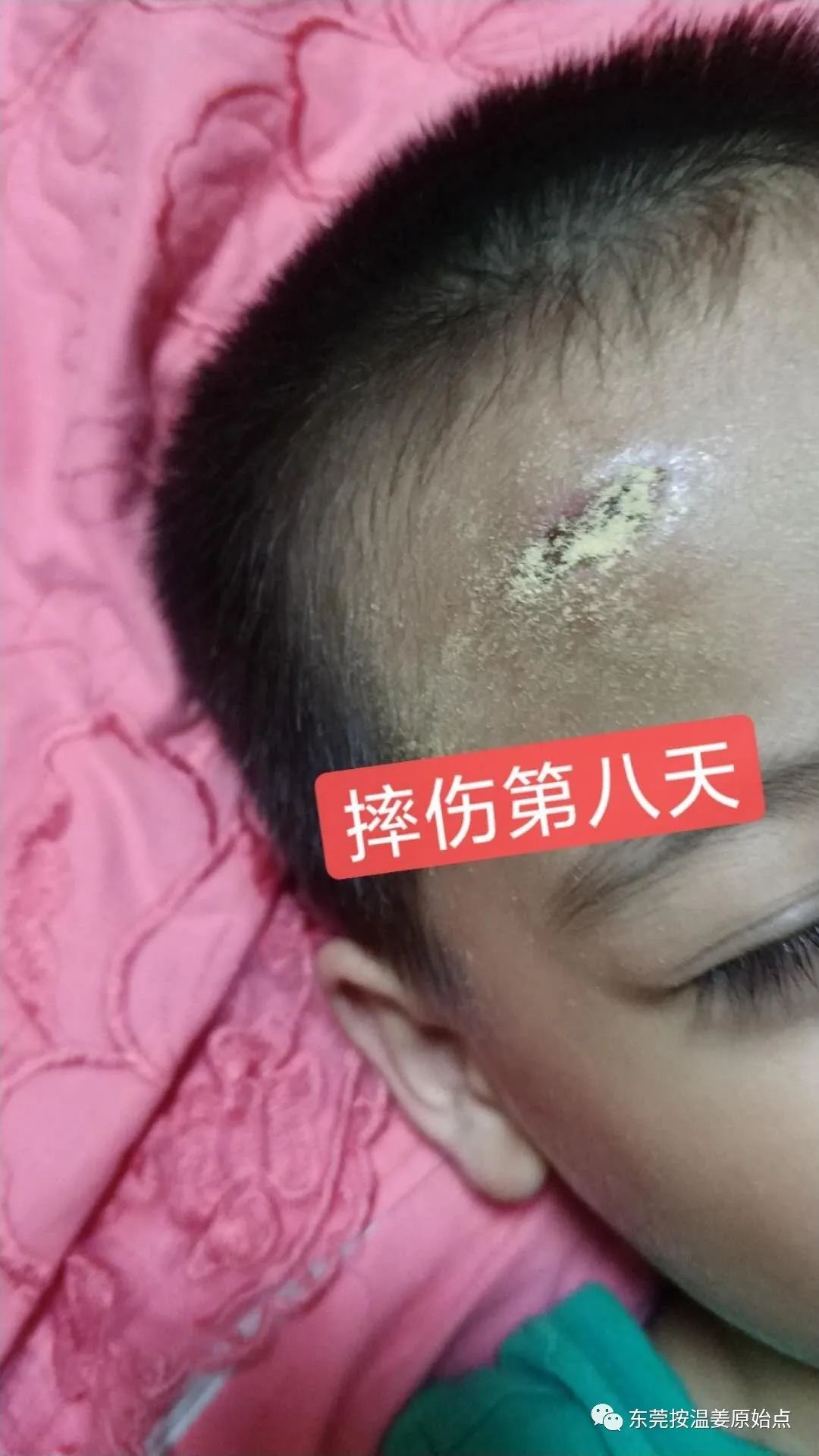 摔伤伤口大约长2CM深0.5CM,未缝针 摔伤伤口大约长2CM深0.5CM,未缝针