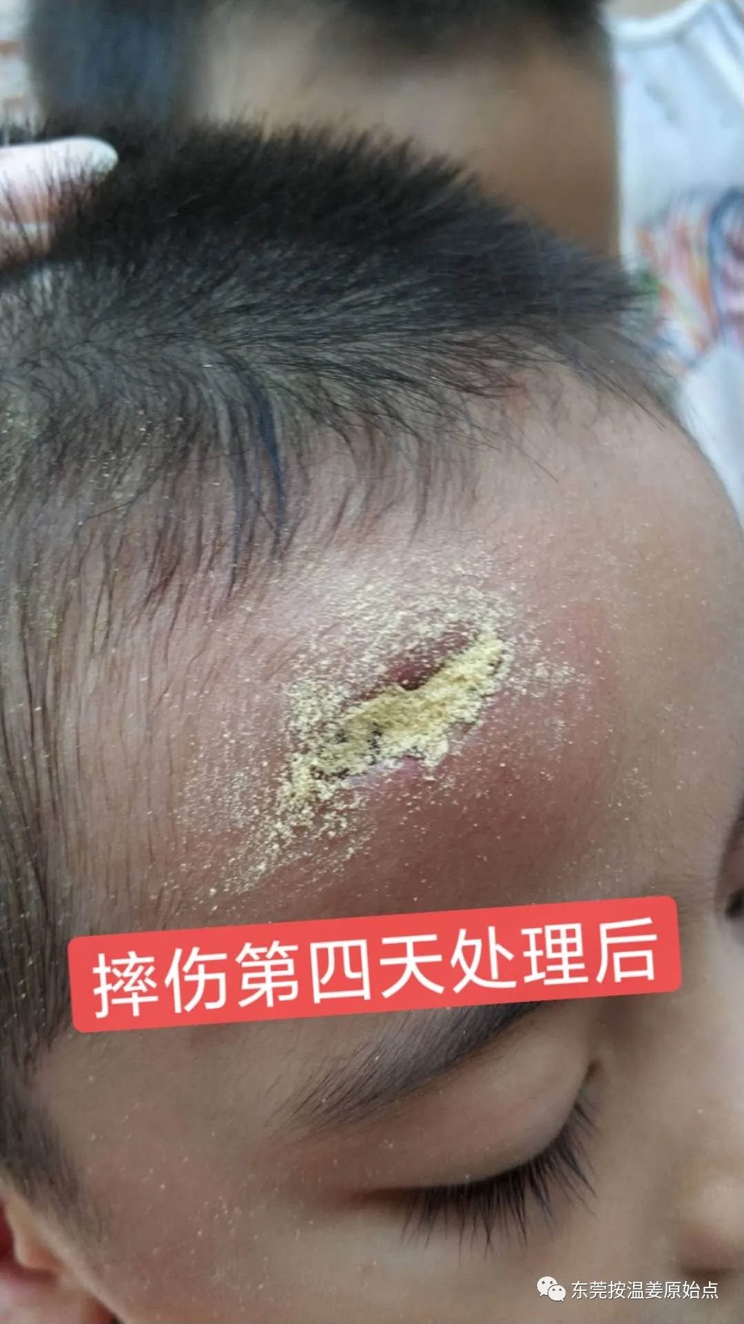 摔伤伤口大约长2CM深0.5CM,未缝针 摔伤伤口大约长2CM深0.5CM,未缝针