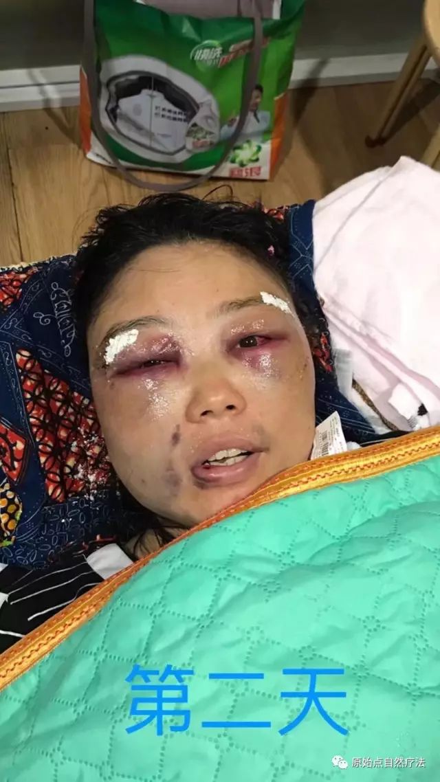 调理车祸案例 调理车祸案例